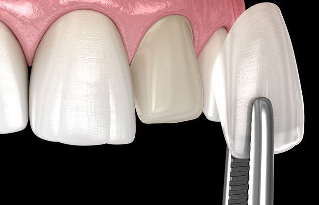 Illustration of veneer being placed on tooth