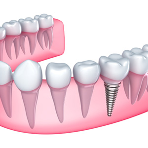 Illustration of single dental implant in lower jaw