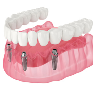 Illustration of dentures being attached to four dental implants