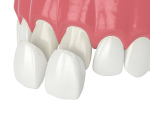 Illustration of veneers being attached to teeth
