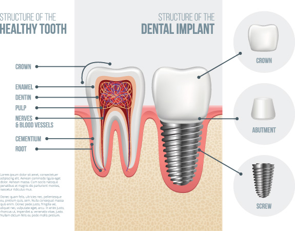 Denture-Implants-Edgewood-WA