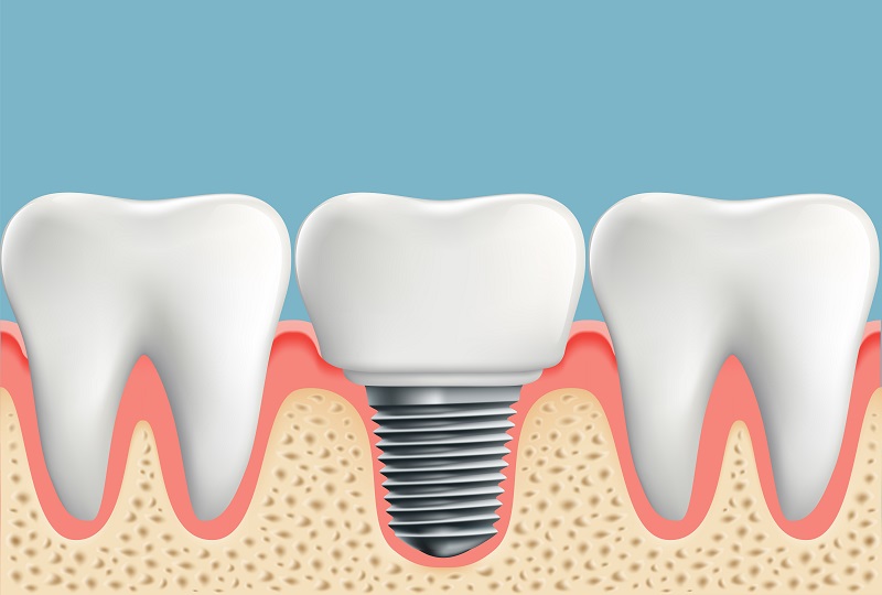 Dental-Implants-Bonney-Lake-WA