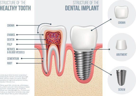 Denture-Implants-Lake-Tapps-WA