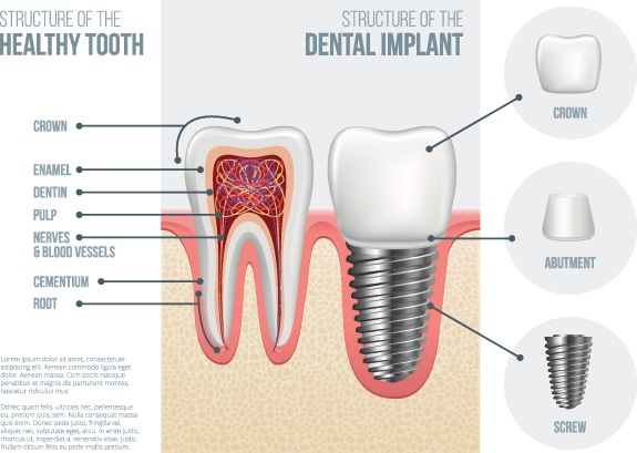 Denture-Implants-Bonney-Lake-WA