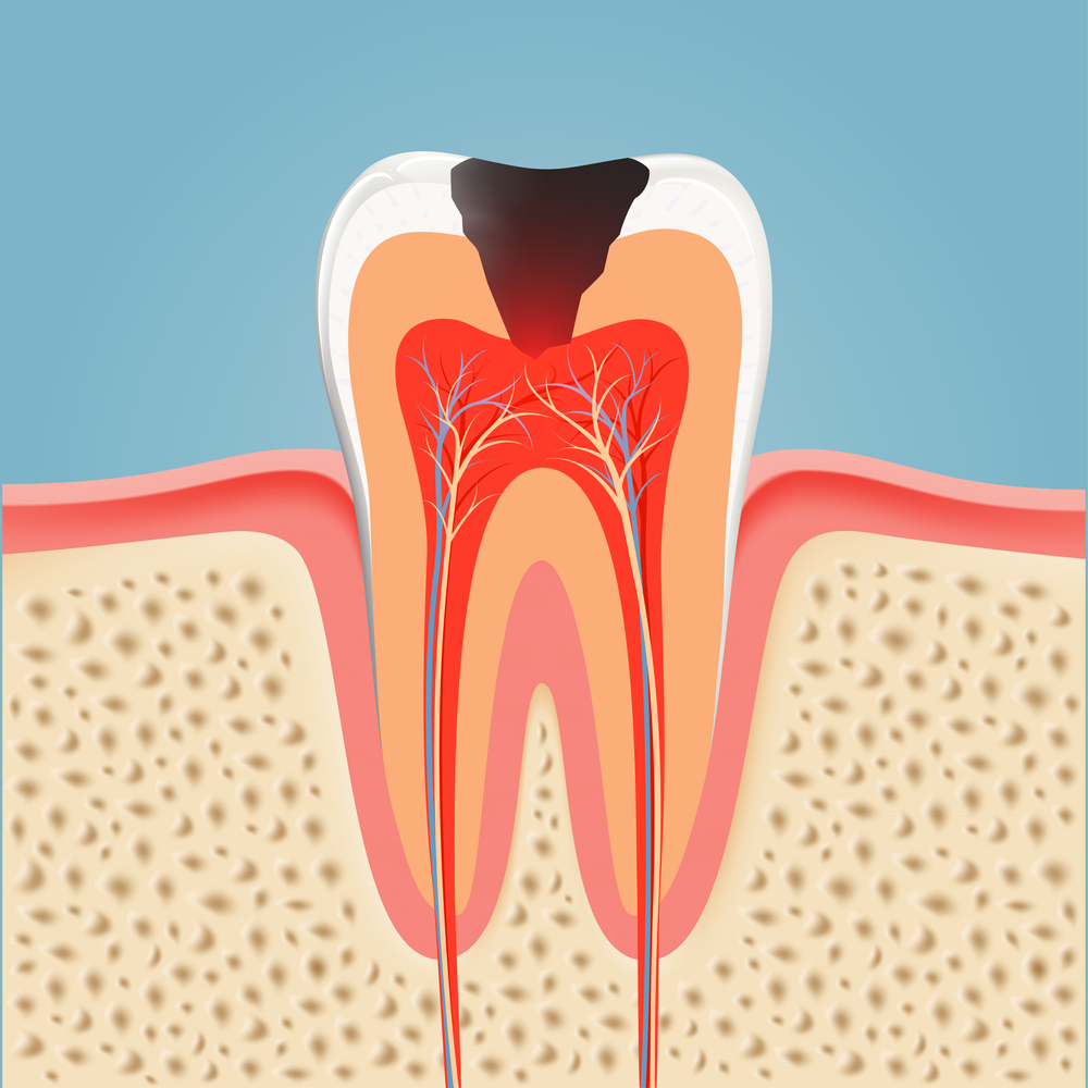 Effective Tacoma endodontics treatment in WA near 98404