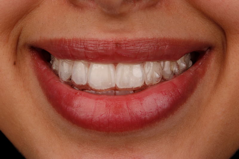 Best Tehaleh teeth aligners in WA near 98391