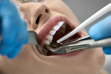 Puyallup dental extractions done painlessly in WA near 98372