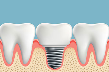Affordable Sumner dental implants in WA near 98390