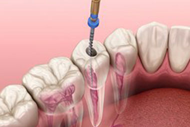 Best Puyallup root canal procedure in WA near 98372